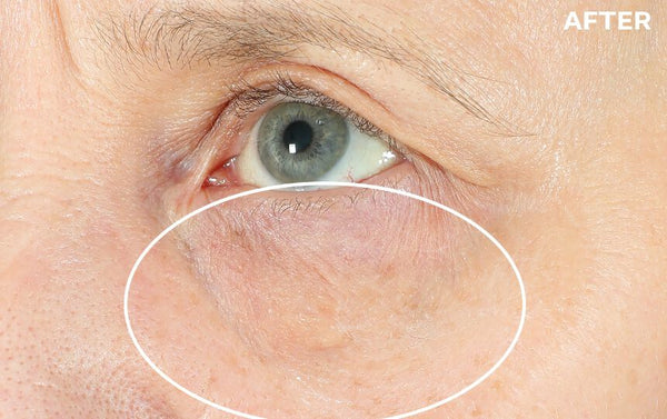 Hyperlift Eye® Instant Eye Fix