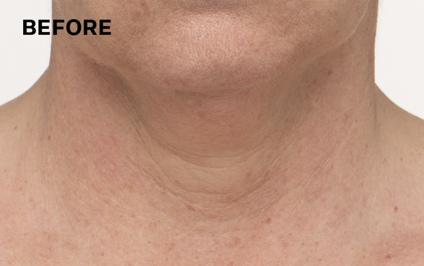Results after 4 weeks using TL Advanced™ Tightening Neck Cream PLUS as directed. Individual results will vary.