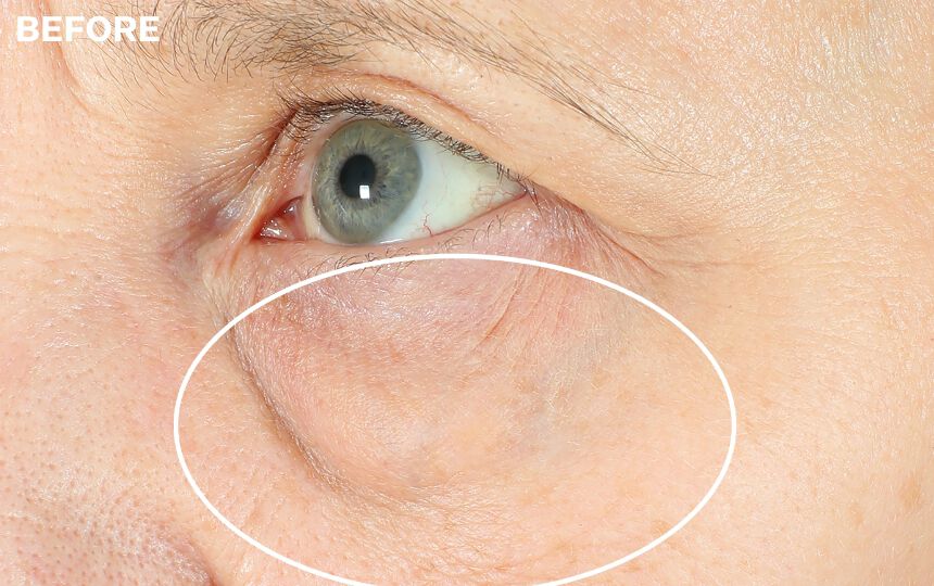  Instant Puffy Eye & Lift Treatment – Removes Under Eye
