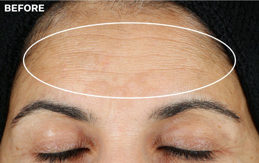 Results after 12 weeks when using Super-C Retinol Brighten & Correct Vitamin C Serum as directed. Individual results will vary.