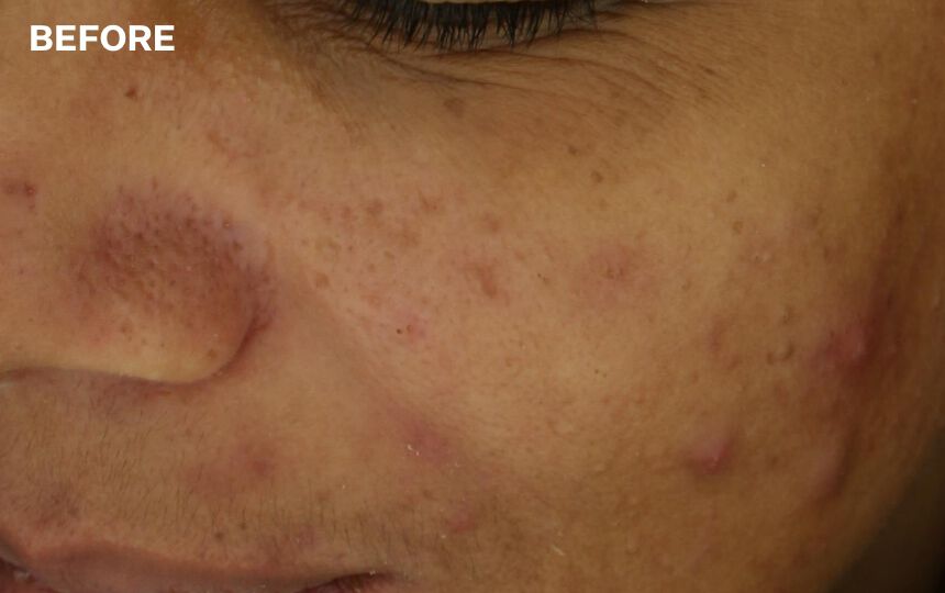 After 8 weeks when Multi-Action Clear Acne Control System is used as a regimen. Unretouched photos. Individual results will vary.