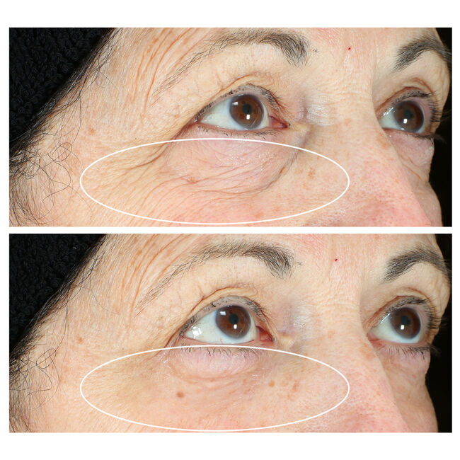 Eye lifting shop serum