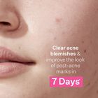 Multi-Action Clear Acne Control System Kit, , hi-res