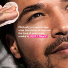 Multi-Action Clear Acne Control System Kit, , hi-res