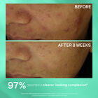 Multi-Action Clear Acne Control System Kit, , hi-res