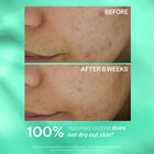 Multi-Action Clear Acne Control System Kit, , hi-res