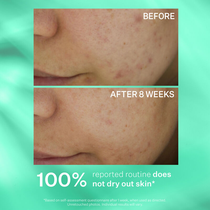 Multi-Action Clear Acne Control System Kit, , hi-res